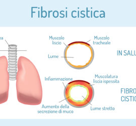 sintomi-fibrosi-cistica