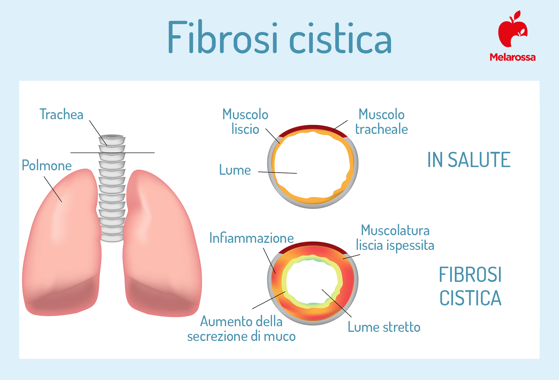 sintomi-fibrosi-cistica